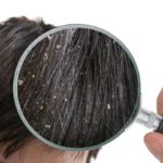 Dandruff Condition and Its Treatment
