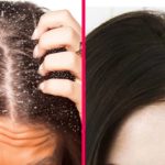 How can you Get Rid of Dandruff?