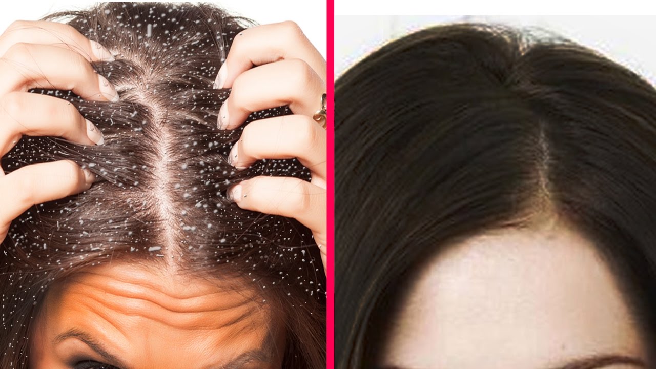 How Can You Get Rid Of Dandruff