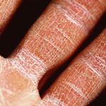 Cure for Eczema - Do Scientists Work on It?
