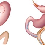 10 Facts about Gastric Bypass - Interesting and Useful Facts