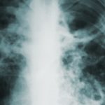 10 Facts about Tuberculosis - Interesting and Useful Facts