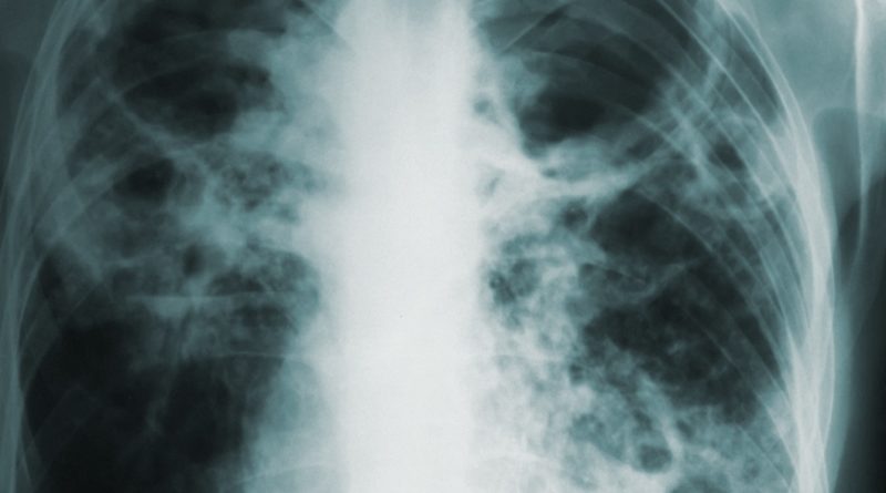10 Facts about Tuberculosis - Interesting and Useful Facts